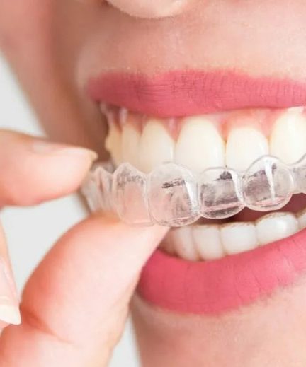 Исправление прикуса брекетами: путь к красивой улыбке