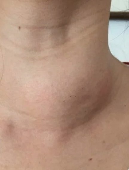 Склеротерапия в Минске: эффективность, особенности и ориентировочная стоимость процедуры