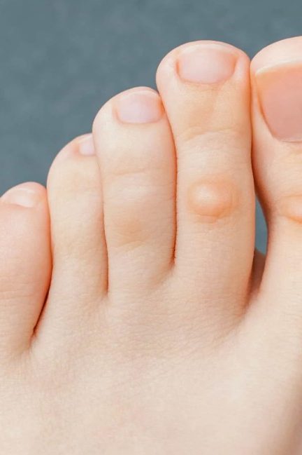 Причины и виды мозолей на ногах