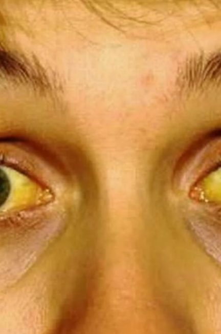 Желтуха при синдроме Жильбера, когда стоит волноваться