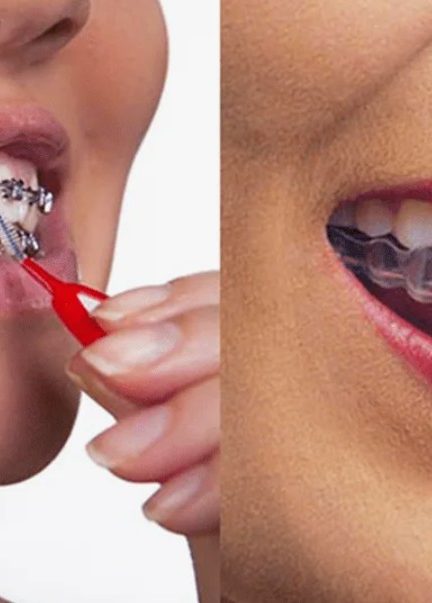 Исправление прикуса: как выбрать между брекетами и элайнерами