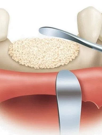 Костная пластика: показания, этапы и восстановление